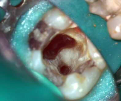 wurzelbehandlung oder wurzelspitzenresektion