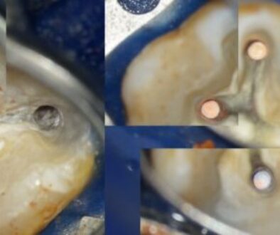 wurzelkanäle übersehen unter dem mikroskop sichtbare wurzelkanäle