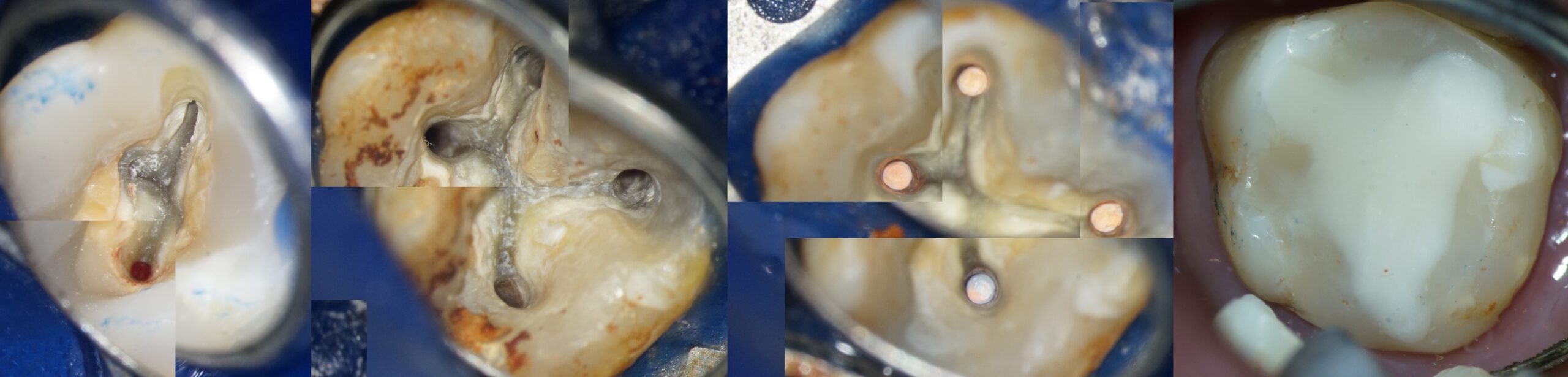 wurzelkanäle übersehen unter dem mikroskop sichtbare wurzelkanäle