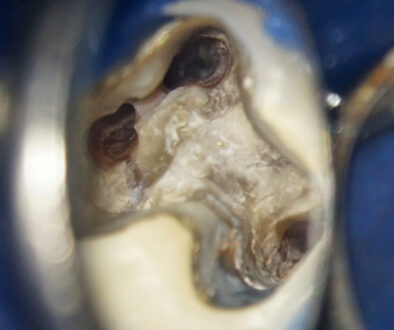 Schmerzen beim Kauen nach Wurzelbehandlung – mögliche Ursachen im Zahn