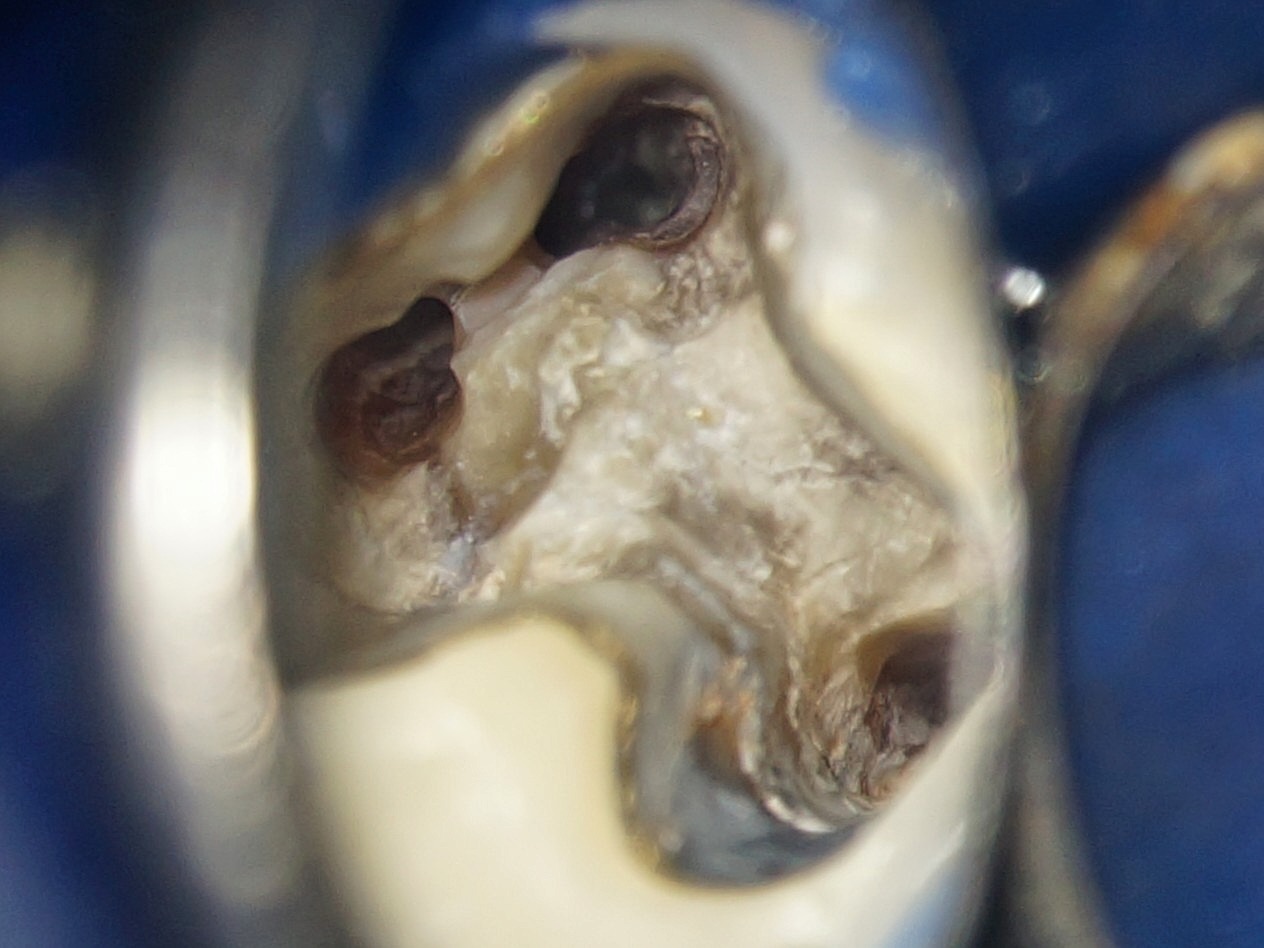 Schmerzen beim Kauen nach Wurzelbehandlung – mögliche Ursachen im Zahn